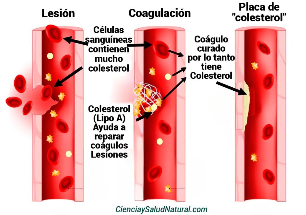 Los Peligros de las Estatinas placa colesterol
